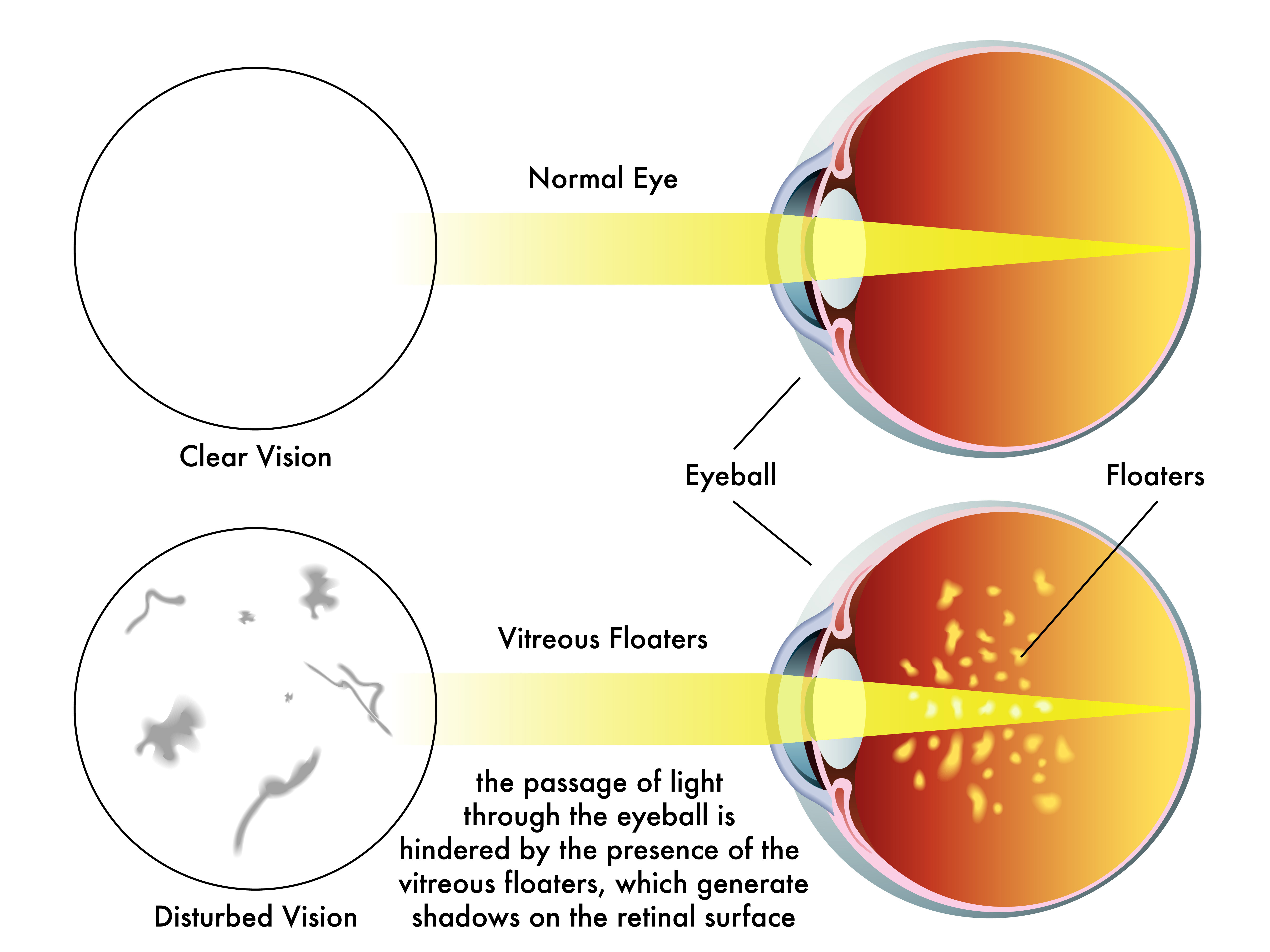 Treatment For Flashes And Floaters Eye Centers Of Florida