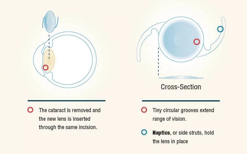 Cataract Lens Implants in Florida Eye Centers of Florida IOLs